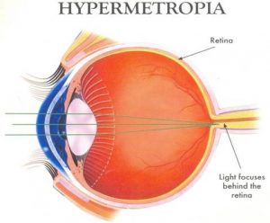 Hypermetropia