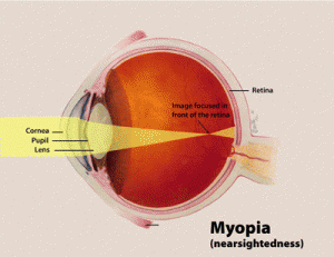 Myopia