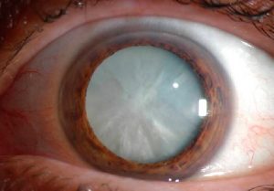 cataract