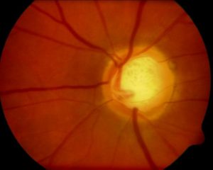 glaucoma-710x568