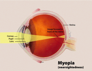 Myopia-1-300x231